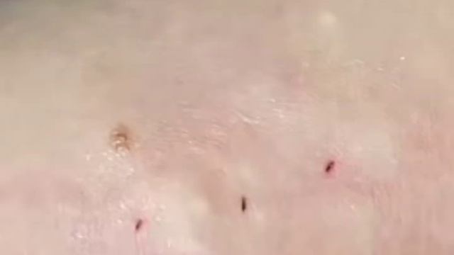 ГНОЙНИЧКИ НА ЛИЦЕ/pick up the pus смотреть онлайн