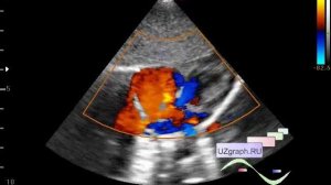 Детское УЗИ сердца (эхокардиография) - Фенестрация МПП / Множественные ДМПП