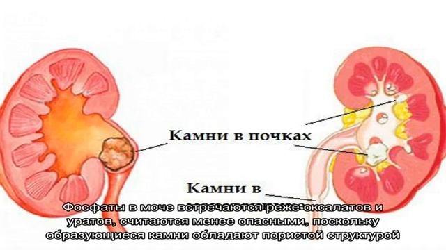 Соли фосфаты в моче у ребенка смотреть онлайн