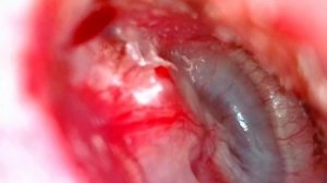 через 1 мес после тимпанопластики