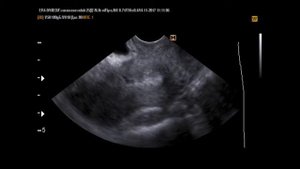 Рубец на матке после КС (14-11-17)УЗИ