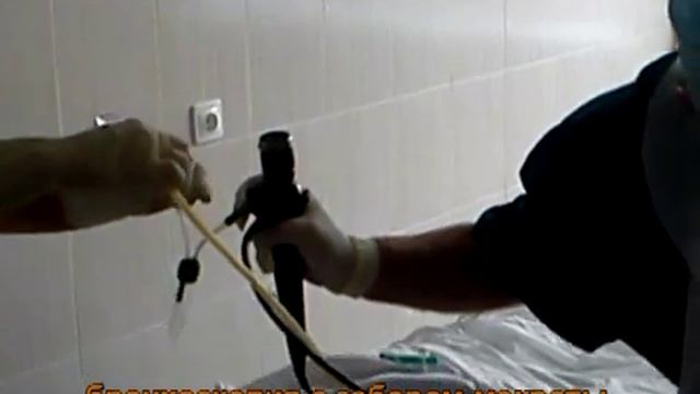 Бронхоскопия с забором мокроты для бак.посева. смотреть онлайн