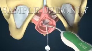 Установка TVT петли