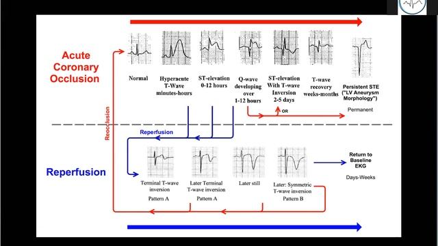 Элевация ST смотреть онлайн