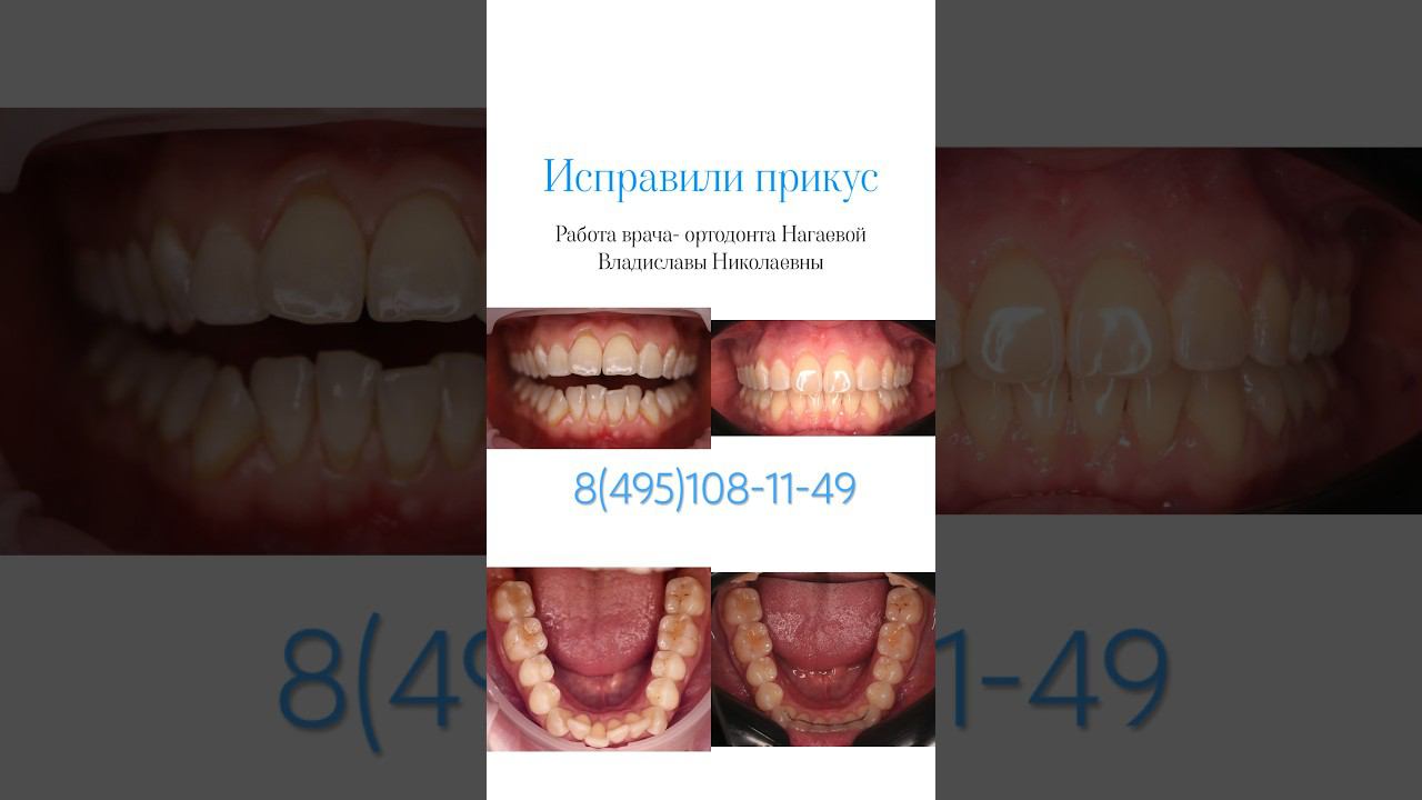 НЕ СТЕСНЯЕМСЯ СВОИХ ЗУБОВ, исправляем прикус #стоматологиямосква #элайнеры #брекеты  #ортодонтия