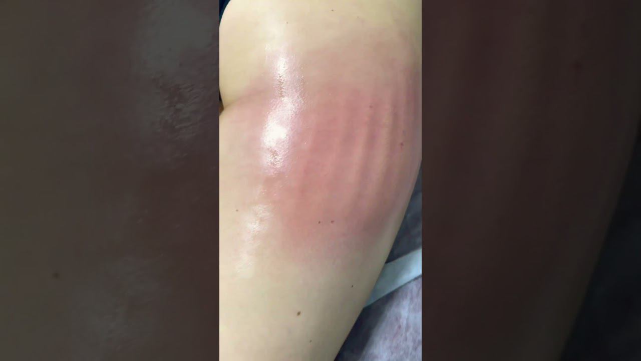 Ручная липосакция галифе #shortvideo #массаж #massage #shorts #похудение #sports #live #tiktok