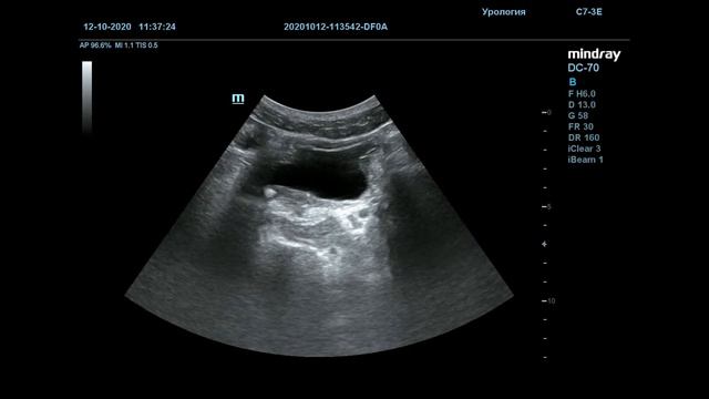 Конкремент устья мочеточника смотреть онлайн