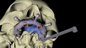 Имплантация по шаблону
