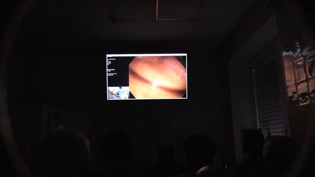 01 1Live Завьялов ДВ Экспертная колоноскопия Холодная петлевая полипэктомия CSP в 30 лет