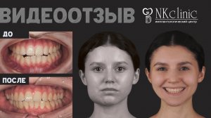 Удаление опухоли (фибромы) нижней челюсти