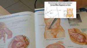 Аппендикс где находится?