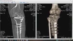 Перелом мыщелка большеберцовой кости (часть 4 из 5)
