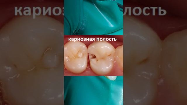 Молочный зуб| Постоянный зуб
