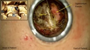 Minimally Invasive Microdiscectomy L5-S1