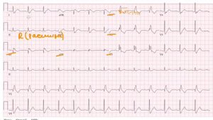 Блокада правой и левой ножки пучка Гиса