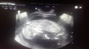 сокращения сердца эмбриона в 5 недель