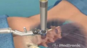 Medtronic: METrx system