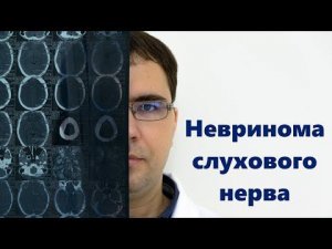 Невринома слухового нерва: симптомы, диагностика, лечение