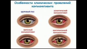 Конъюнктивит