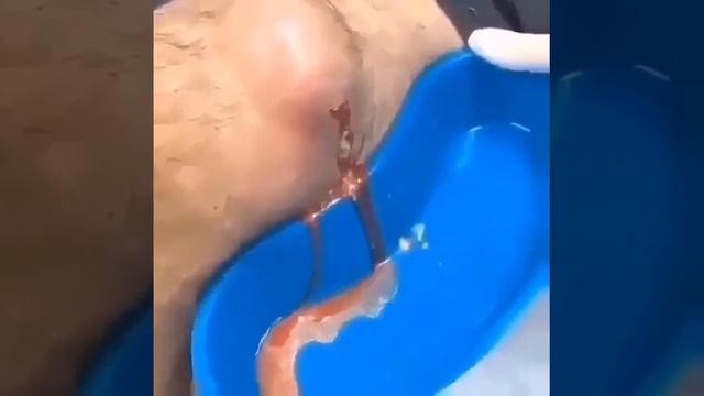 Нагноение чири... Почему следует обращаться к доктору вовремя