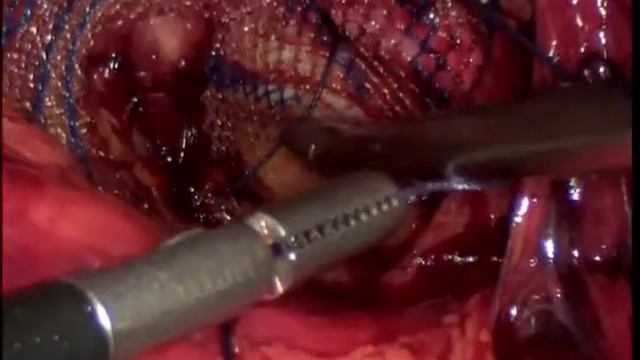 Лапароскопическая герниопластика ТАРР смотреть онлайн