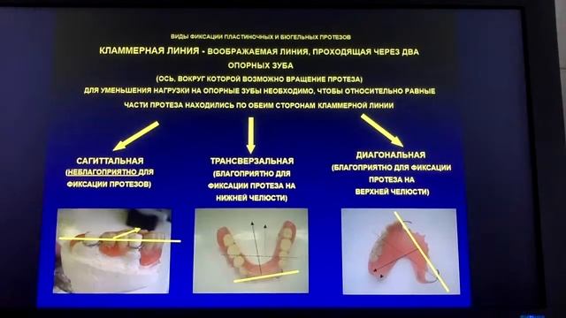 Виды фиксации пластиночных и бюгельных протезов. Перекрывающие протезы. Биомеханика смотреть онлайн