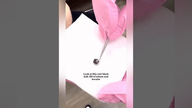 Акне. Черные точки. Вросшие волосы и прыщи. смотреть онлайн