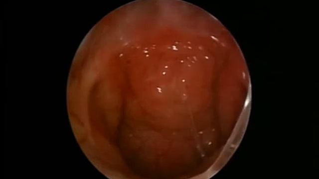 Недоразвитие сошника, расщелина мягкого неба.mp4 смотреть онлайн