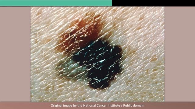 Melanoma: Image Gallery