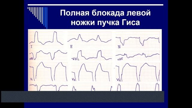 Желудочковые блокады. Куприянова А.В. смотреть онлайн