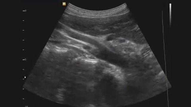 Локализация истоков почечных артерий относителельно верхней брыжеечной артерии
