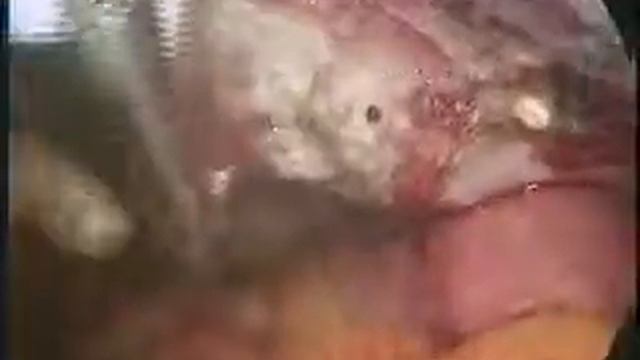 Лапароскопічна тотальна гістеректомія (повне відео) смотреть онлайн