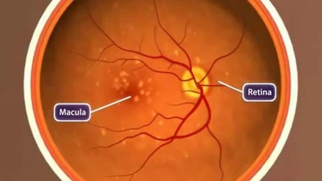 Дистрофия сетчатки центральная
