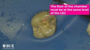 Access Cavity Preparation for molars