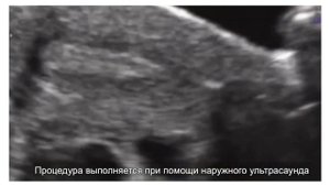 Этот ролик представляет процесс подсадки эмбрионов в матку
