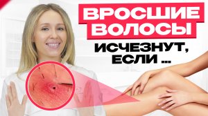 От ВРОСШИХ ВОЛОС - обязательно! Что делать до и после депиляции, эпиляции, шугаринга.