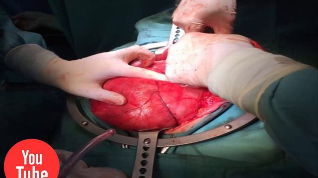 Phát hoảng với khối u mỡ nặng tới 6kg trong ổ bụng - [Tin mới 123] смотреть онлайн