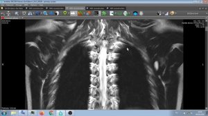 МРТ  ШЕЙНО ГРУДНОГО ОТДЕЛА