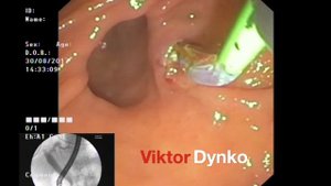 РХПГ (ERCP): Холедохолитиаз. Парапапиллярный дивертикул