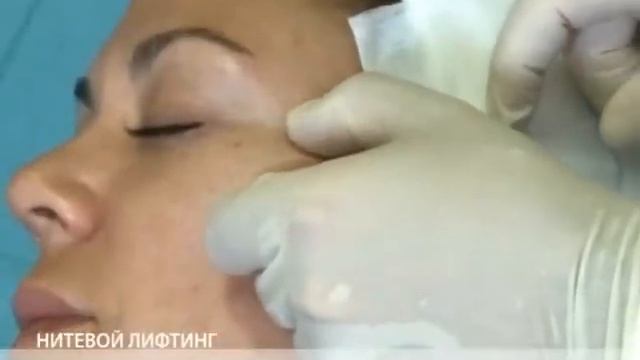 Нитевой лифтинг смотреть онлайн