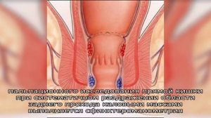 Ощущение зуда в заднем проходе после антибиотиков