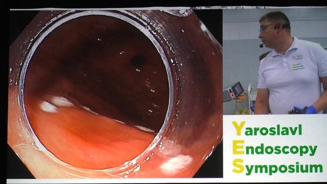 12Live Шишин КВ T1N0M0 рак желудка ESD смотреть онлайн