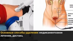 Удаление камней из мочеточника