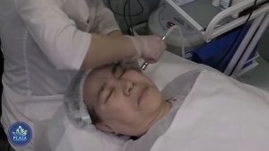 Алмазный пиллинг или алмазная дермобразия