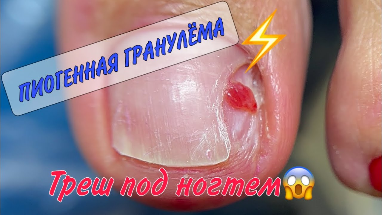 ⛔️пиогенная гранулема _😱сюрприз под ногтем_ помощь у подолога