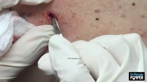 Large Blackheads on the Back