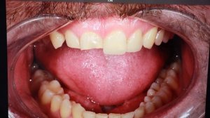 СТОМБУДНИ#21 СЛОМАЛ ВИНТ ИМПЛАНТА!!!