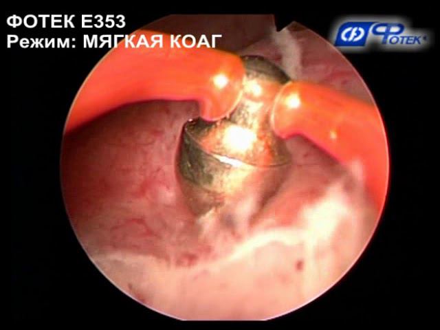 Коагуляция опухоли мочевого пузыря смотреть онлайн