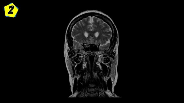 ОН вызывает ИНФАРКТ, ИНСУЛЬТ, ДИАБЕТ! Знай врага в Лицо смотреть онлайн