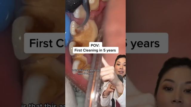 5 years of plaque build up. Get your cleanings! #plaque #tartar #buildip #dentist #dentistry